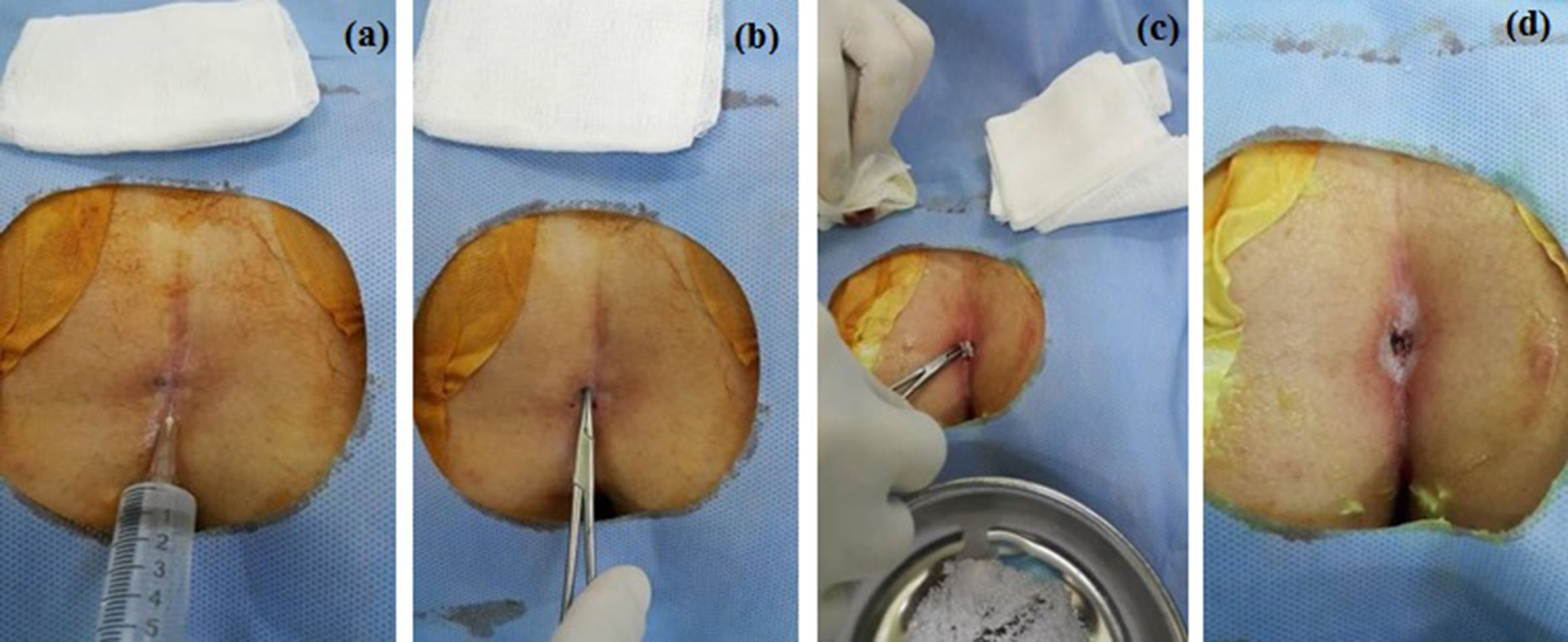 Pilonidal abscess forums - Pilonidal Support Pilonidal abscess forums - Pilonidal Support