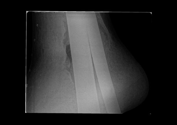 X-ray image of David's left foot showing the metal armature penetrating into the base. Image © Intertek NDT.