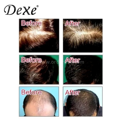 Dexe Anti-Hair Loss Lotion, 10 x 6ml — 4