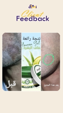 جل الصبار ديرموكيل لترطيب البشرة ومعالجة حروق الشمس | Dermokil Aloe Vera Gel for Hydratio… — 2