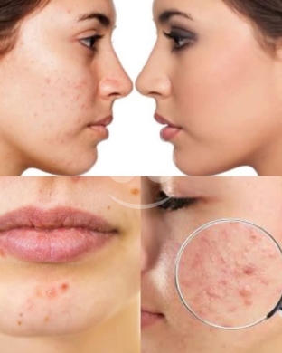 Goodbye Acne, Hello Glow! - وداعاً لحب الشباب، مرحباً بالبشرة المشرقة — 4