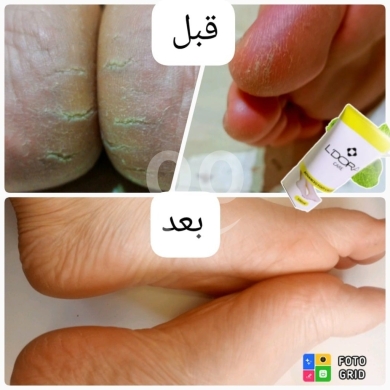 الصحة والجمال بمنتجات طبيعية لعلاج تشققات القدمين والرائحة الكريهة — 6
