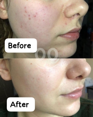 سيروم حمض الهيالورونيك المرطب لتجديد نضارة البشرة | Hyaluronic Acid Serum for Hydration &… — 3