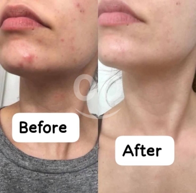 Health & Beauty in Tripoli - سيروم حمض الهيالورونيك المرطب لتجديد نضارة البشرة | Hyaluronic Acid Serum for Hydration & Glow