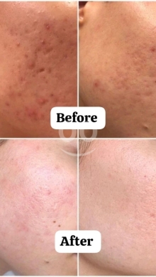 سيروم حمض الهيالورونيك المرطب لتجديد نضارة البشرة | Hyaluronic Acid Serum for Hydration &… — 2