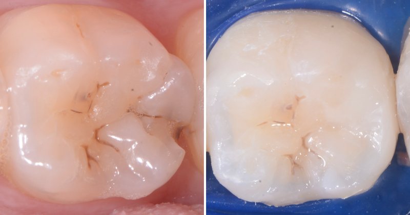 Bruxism and Posterior Restorations: Choosing the Right Solutions for Long-lasting Dental Health