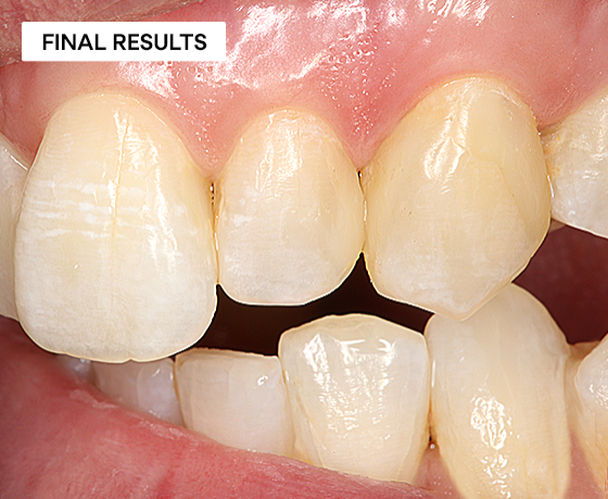 Cracking the chameleon effect using 3M Filtek Easy Match Universal Restorative