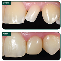 Simple peg-shaped lateral restoration using 3M Filtek Easy Match Universal Restorative