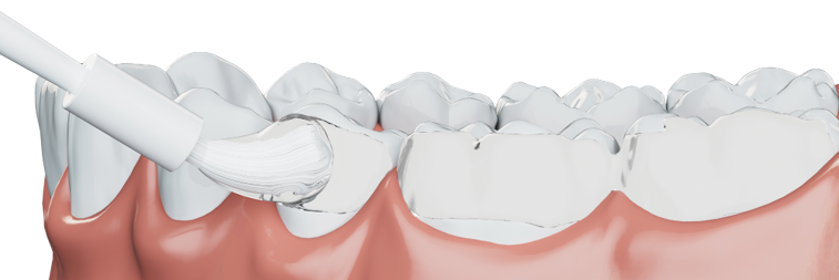 Efficient, patient-friendly fluoride treatment with less fluoride: Discover 3M Clinpro Clear 