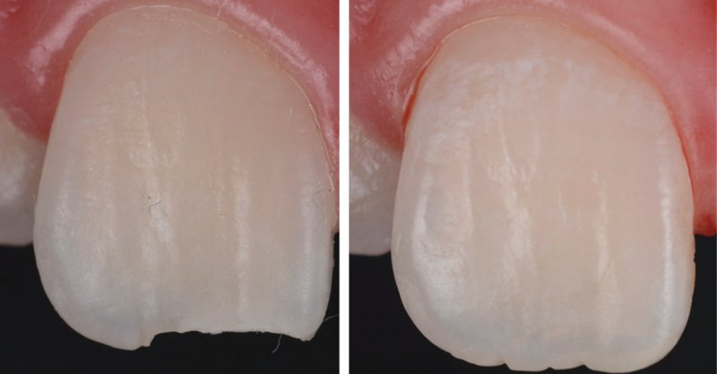 Flowable Composites: Where They Fit In The Workflow.