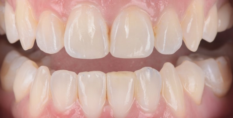 Aesthetic refinement with 3M Filtek Easy Match Universal Restorative