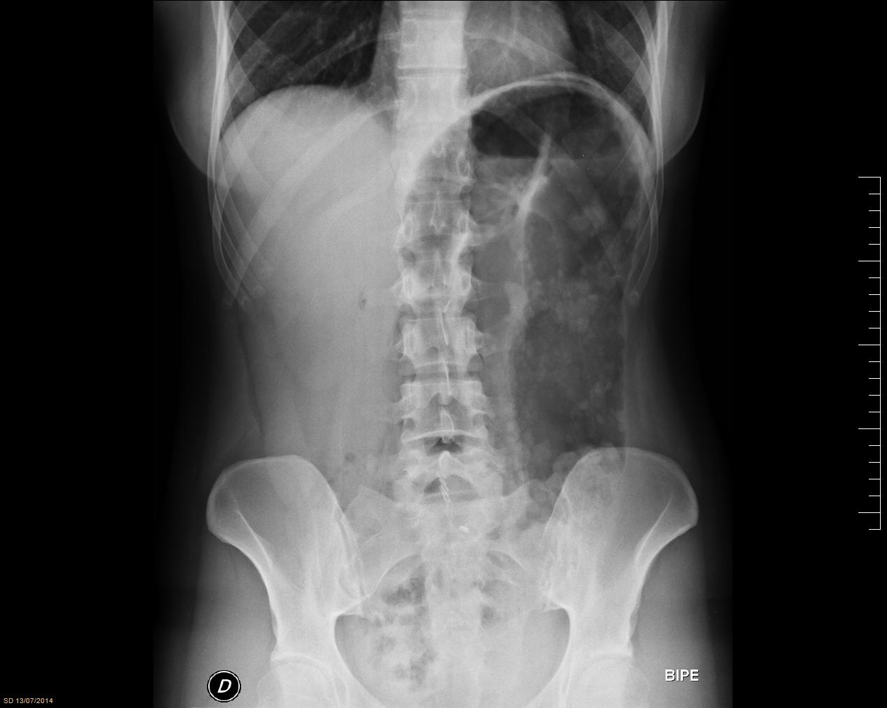 Rx Dilated Pouch