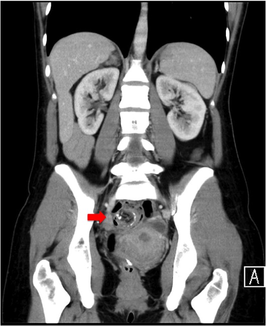 Twisted mesentery