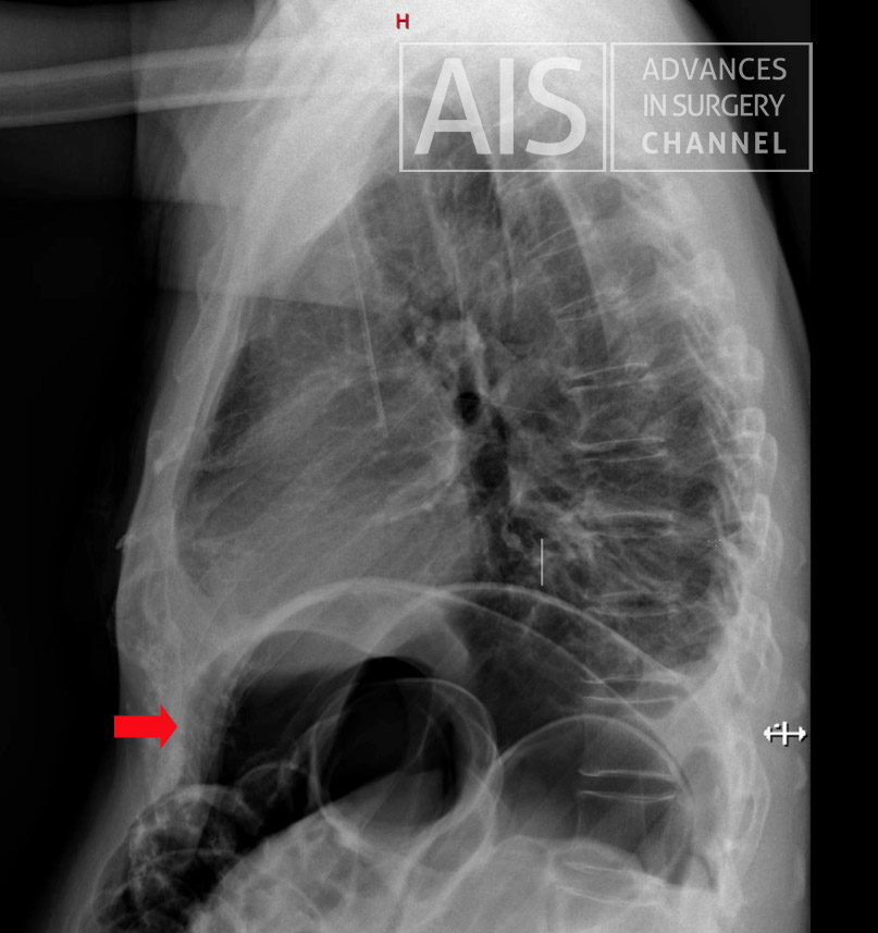Pneumoperitoneum LAT