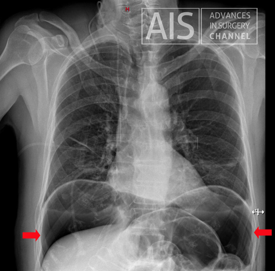 Pneumoperitoneum AP