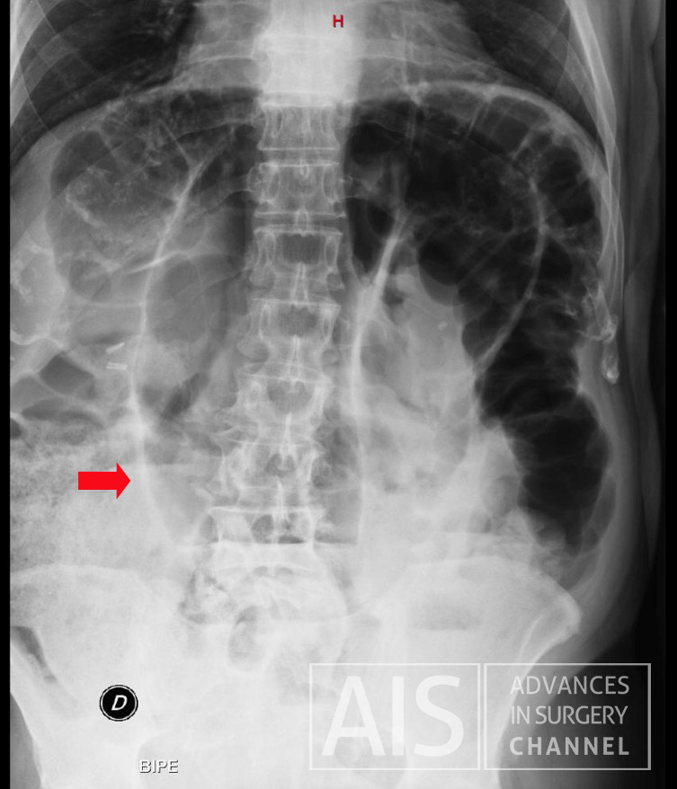 Sigmoid volvulus - coffee bean sign