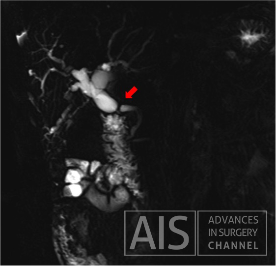 Dilatation of intra hepatic duct and biliary stenosis
