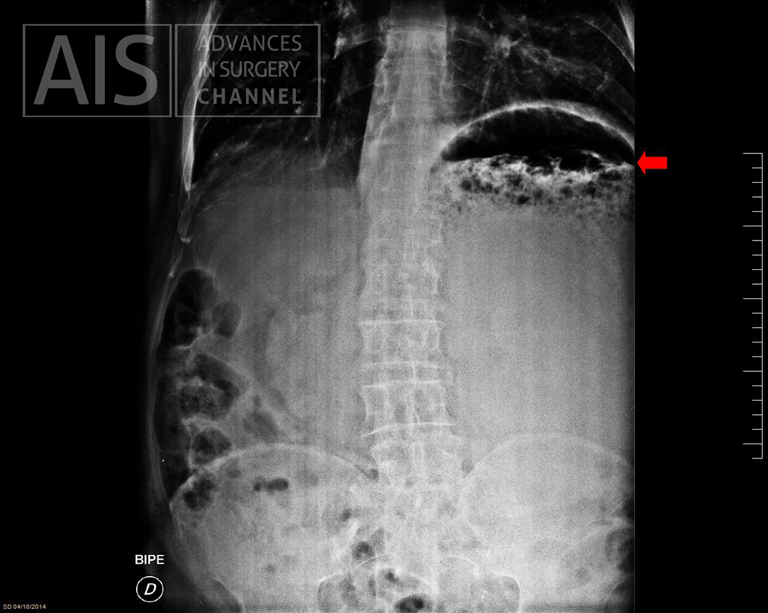Gastric hydric level