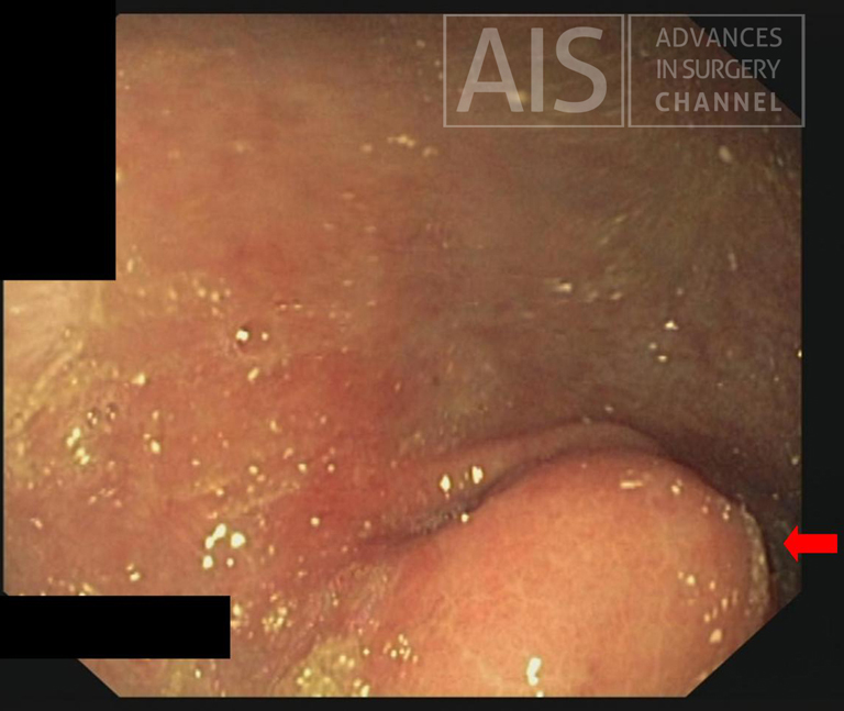 Submucosal elevation at the antrum