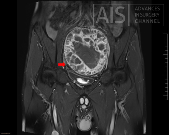 Big pelvic mass with defined borders and compressing surrounding organs
