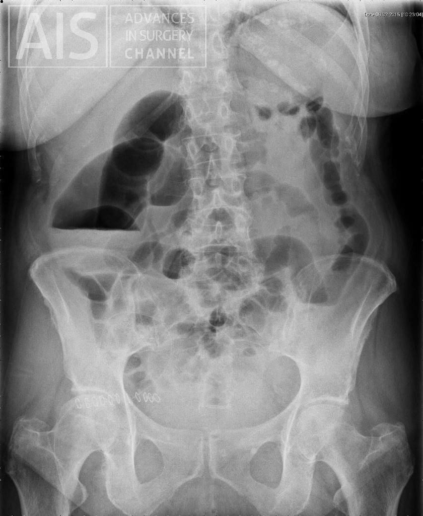 FIG 1. Dilated Loop