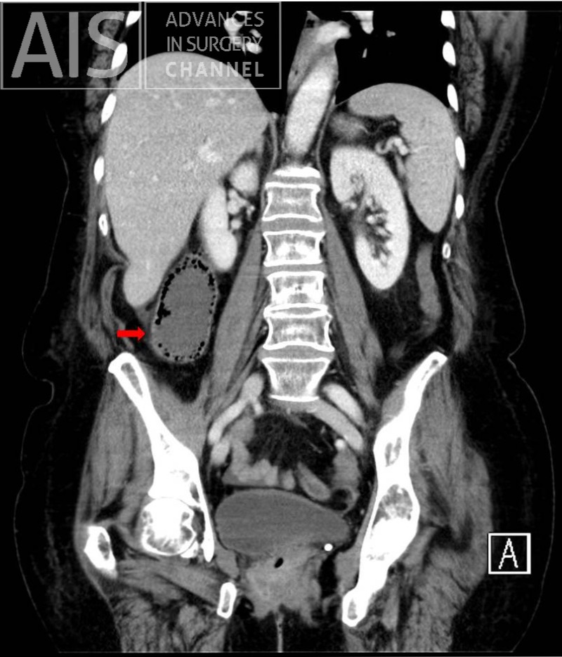 FIG 2. Dilated colon pseudofecaloid pattern