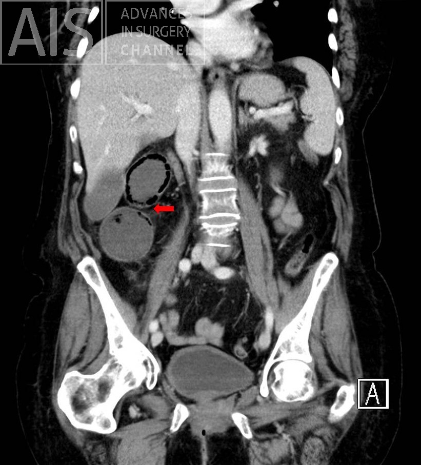FIG 3. Change of caliber