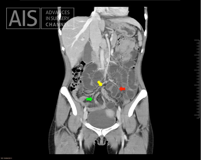 FIG 1. Red arrow- dilated small bowel - Yellow arrow- sigmoid colon - Green arrow- collapsed small bowel