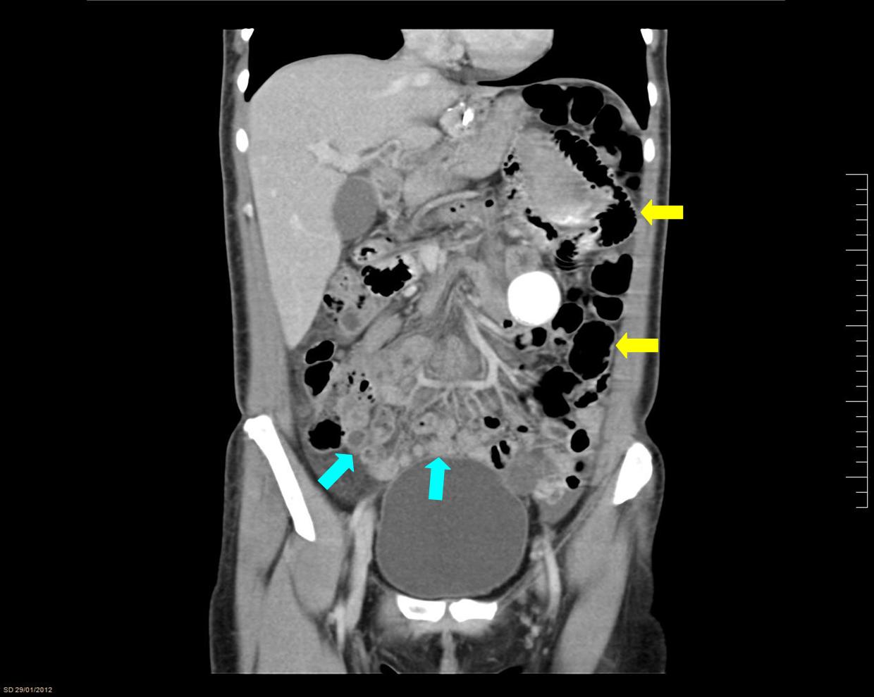 FIG 1. Dilated Small bowel (Yellow arrow) Collapsed small bowel (Blue arrow)