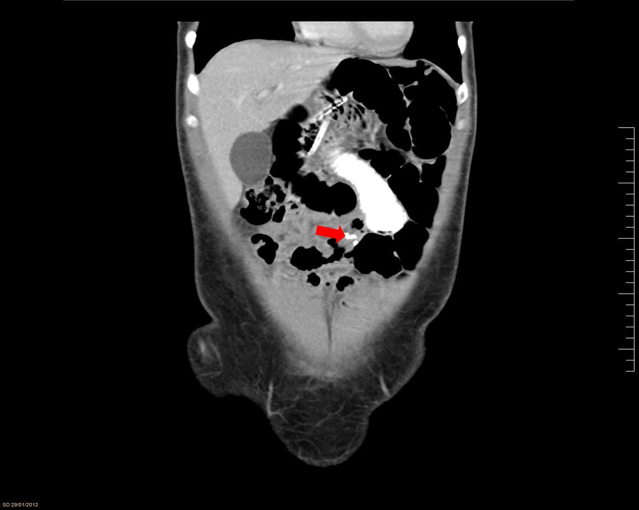FIG 2. Jejuno-jenunal anastomosis