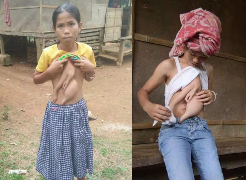 parasitic twin sister girl