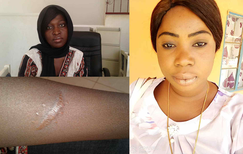 Human Trafficking Survivor: “When I Woke Up, I Realized My Kidney Was Gone”