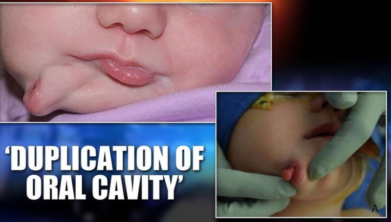 Baby born with two mouths